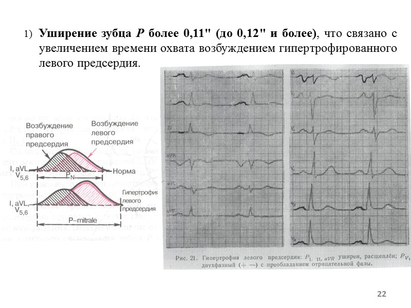 1) Уширение зубца Р более 0,11 1) Уширение зубца Р более 0,11
